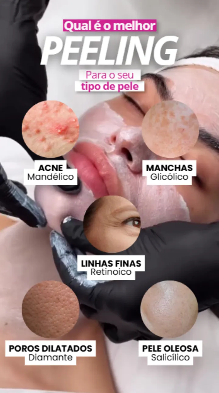Cada tipo de pele pede um peeling diferente